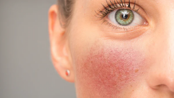 Behandlung von Rosacea: Können Mikronährstoffe unterstützen?